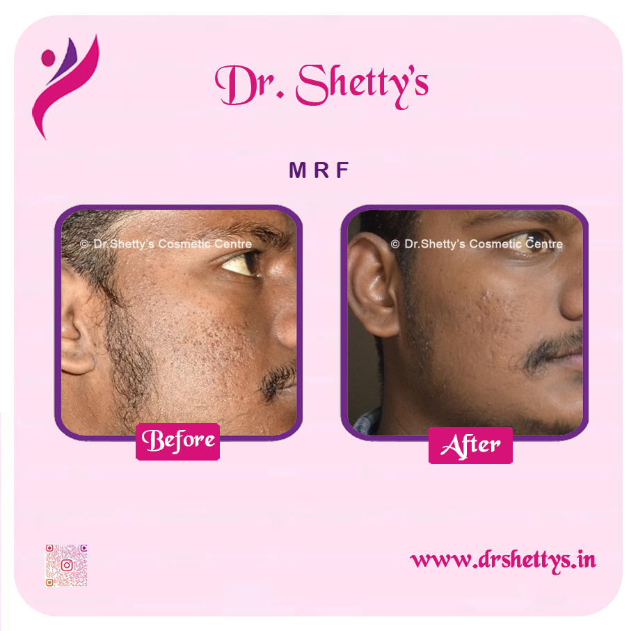 Pimple and Acne Scar Treatment 15