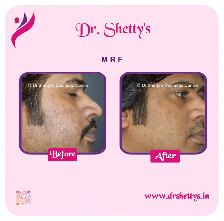 Pimple and Acne Scar Treatment 16