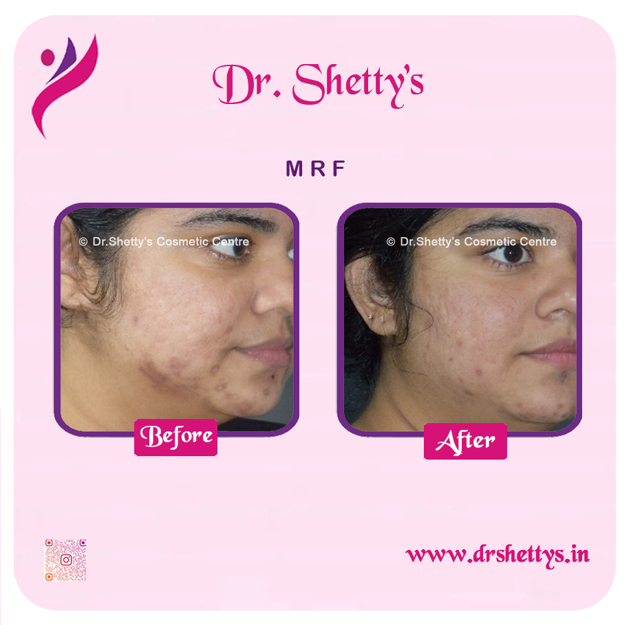 Pimple and Acne Scar Treatment 17