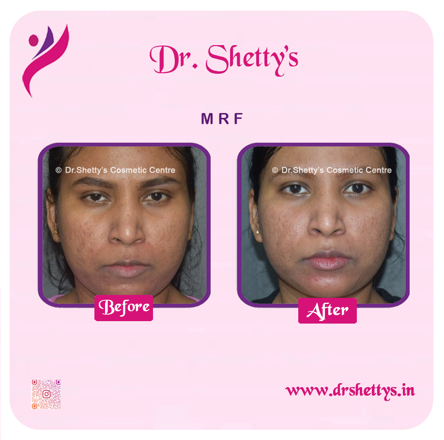 Pimple and Acne Scar Treatment 18