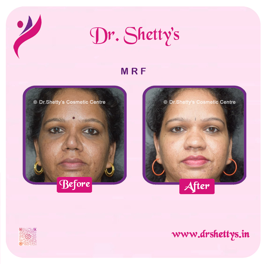 Pimple and Acne Scar Treatment 19