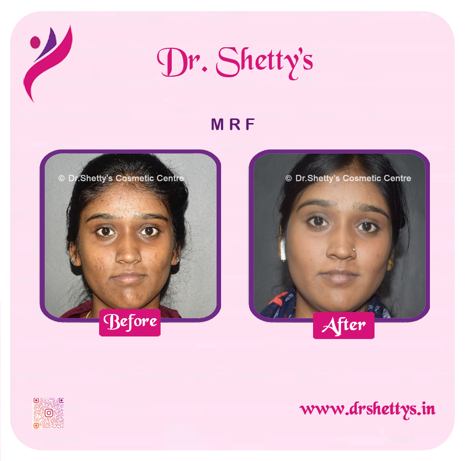 Pimple and Acne Scar Treatment 2