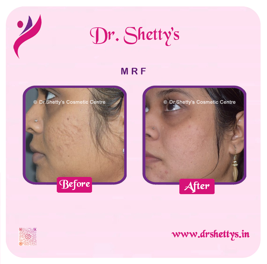 Pimple and Acne Scar Treatment 20
