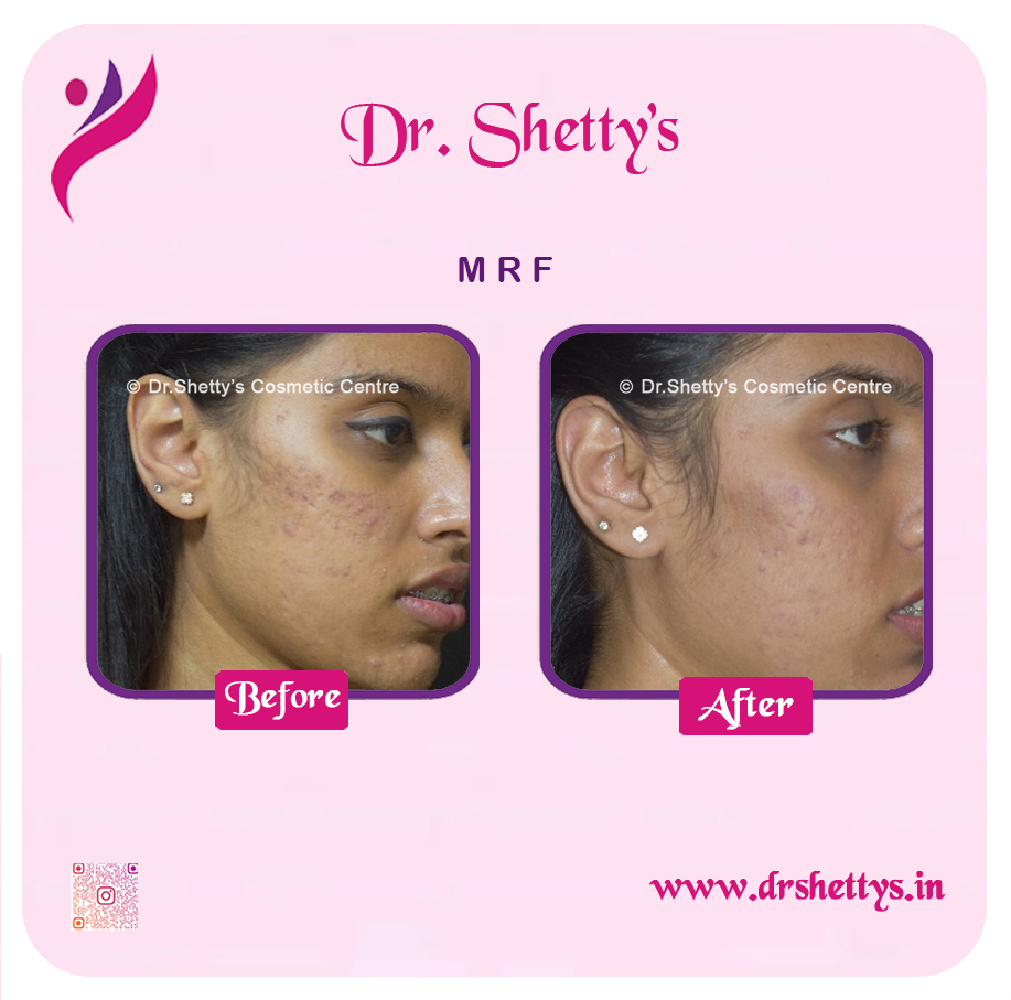 Pimple and Acne Scar Treatment 21