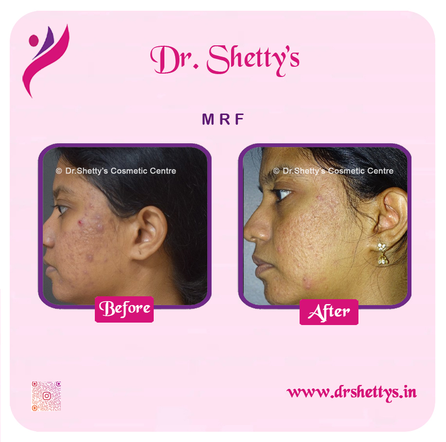 Pimple and Acne Scar Treatment 23