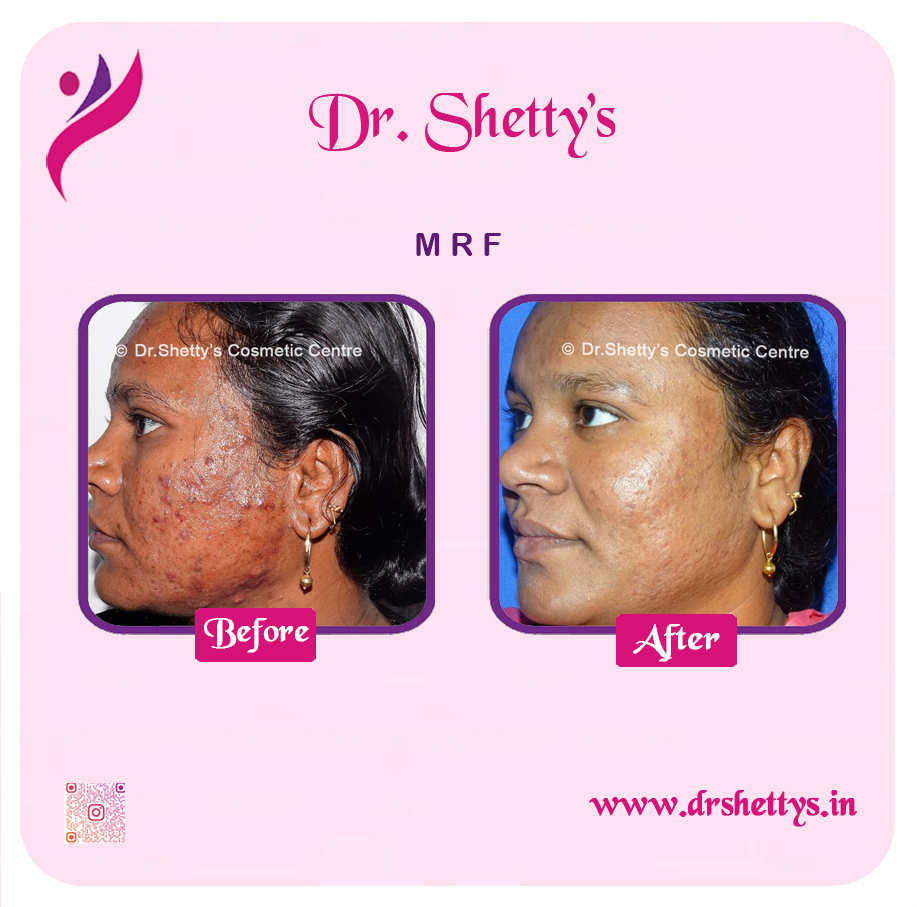Pimple and Acne Scar Treatment 24