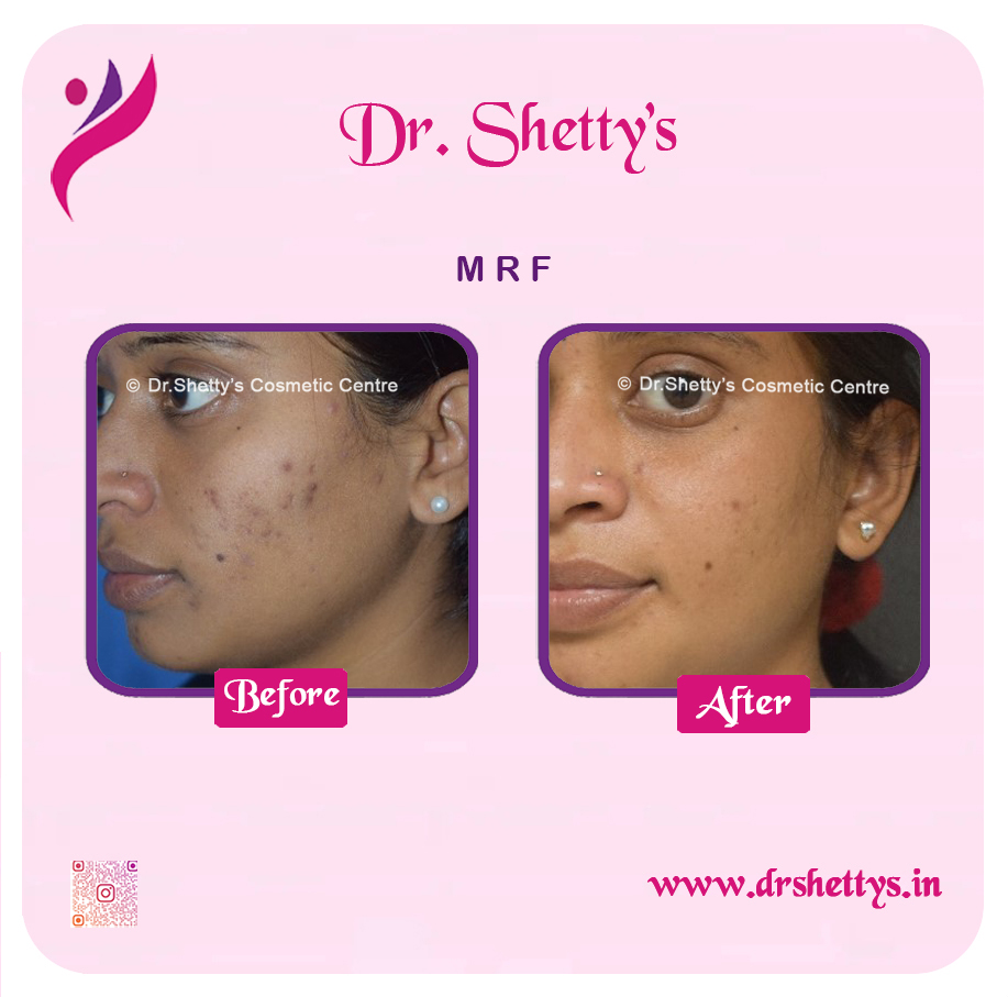 Pimple and Acne Scar Treatment 27