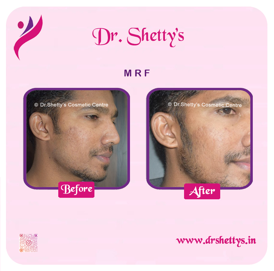 Pimple and Acne Scar Treatment 28