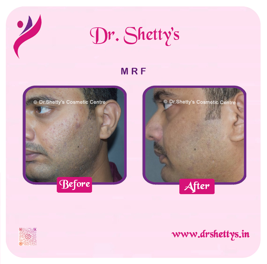 Pimple and Acne Scar Treatment 30