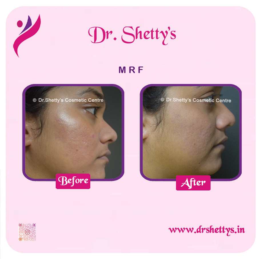 Pimple and Acne Scar Treatment 31