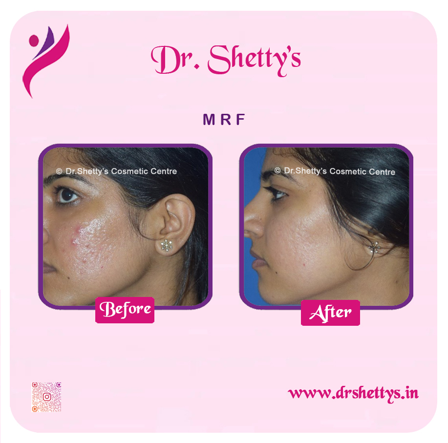 Pimple and Acne Scar Treatment 32