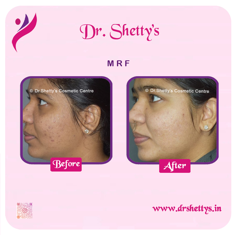 Pimple and Acne Scar Treatment 33