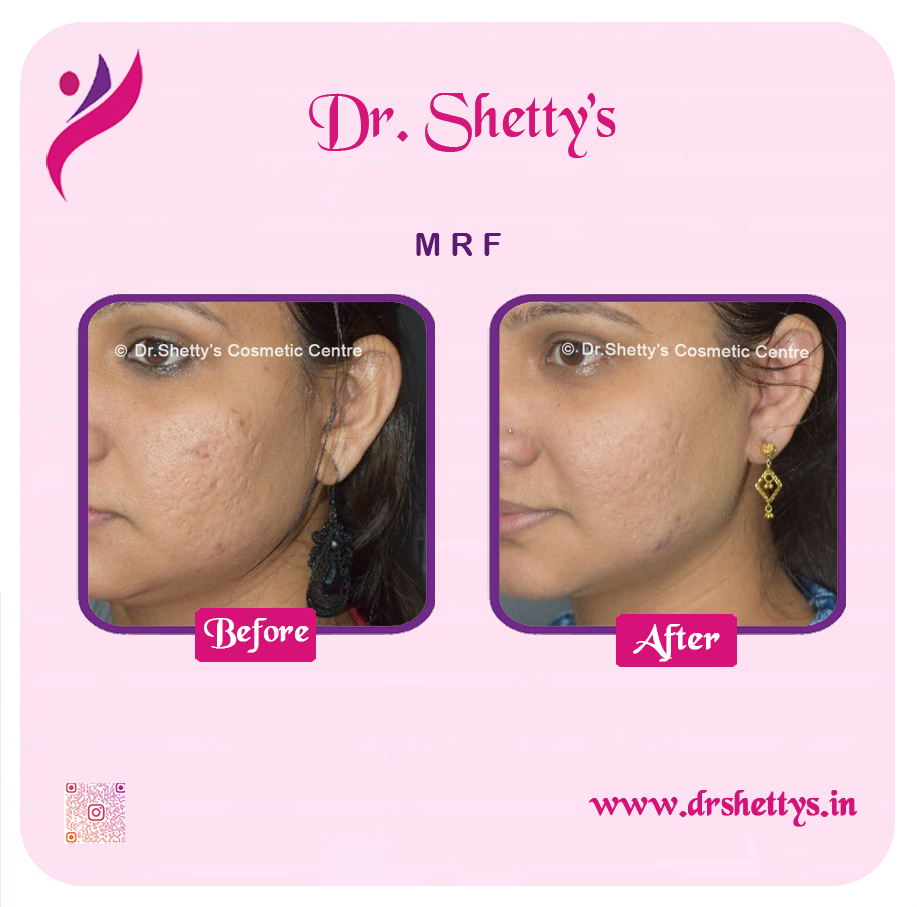 Pimple and Acne Scar Treatment 34