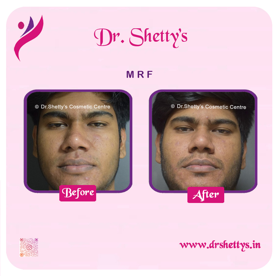 Pimple and Acne Scar Treatment 35