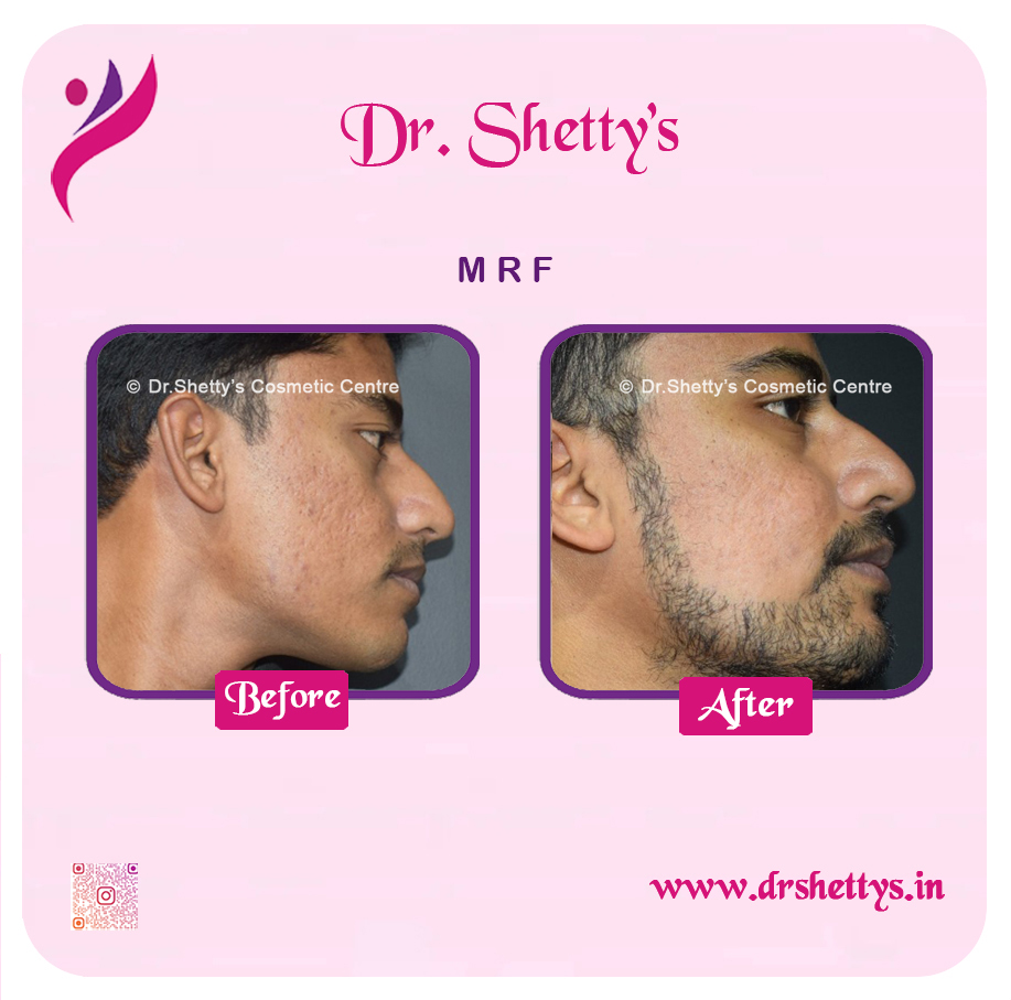 Pimple and Acne Scar Treatment 4