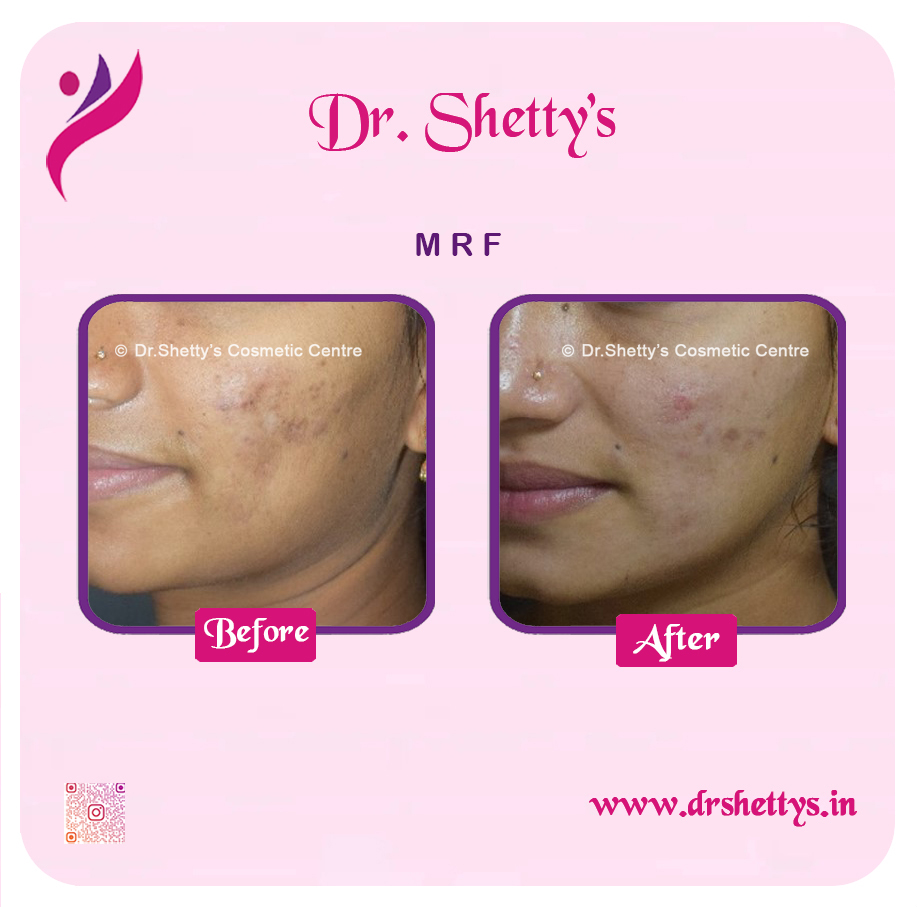 Pimple and Acne Scar Treatment 6