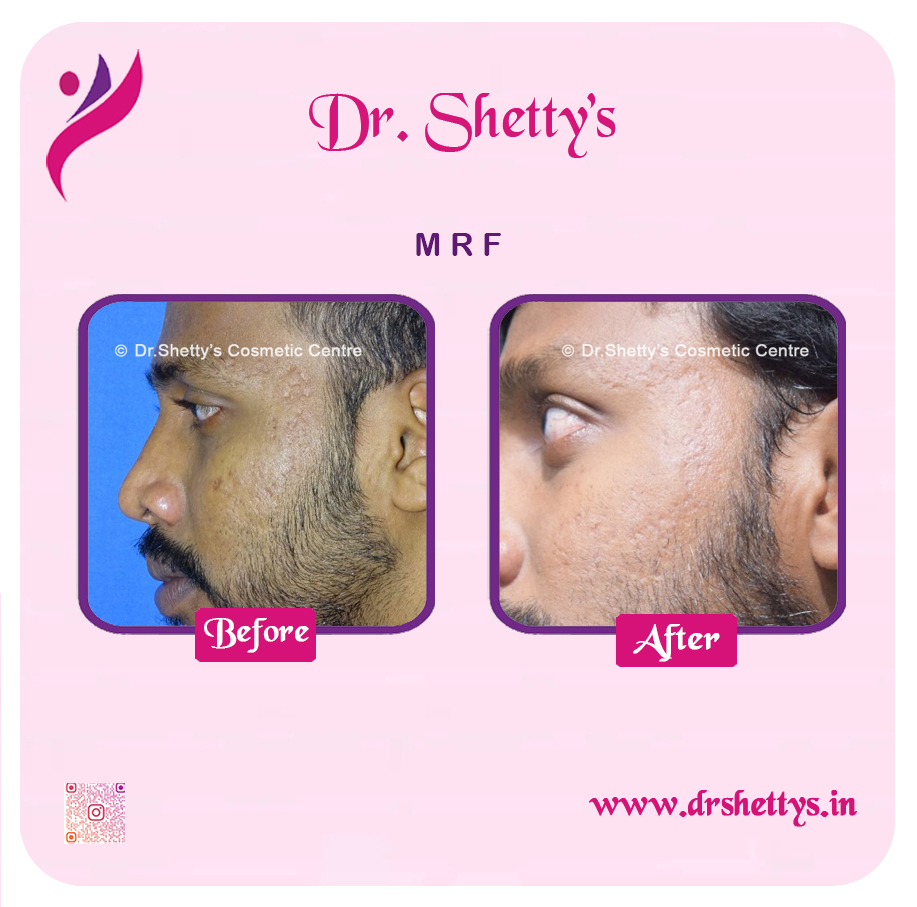 Pimple and Acne Scar Treatment 7