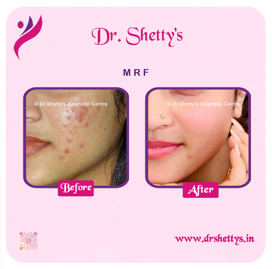Pimple and Acne Scar Treatment 8