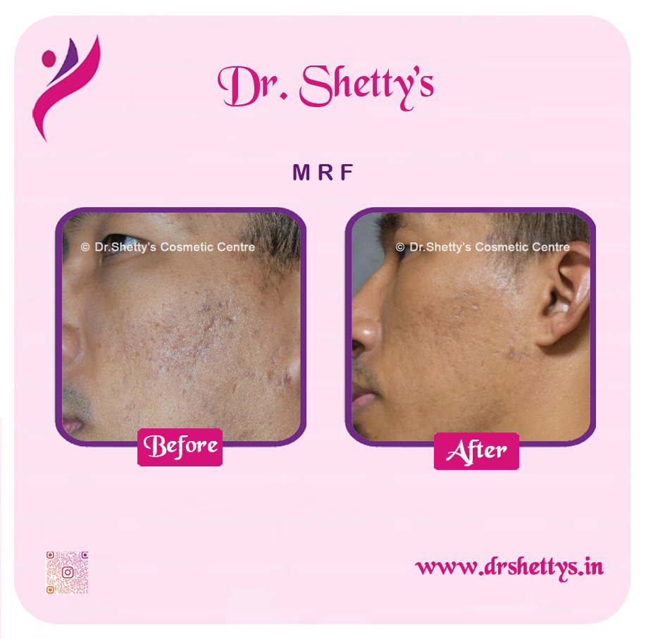 Pimple and Acne Scar Treatment 9