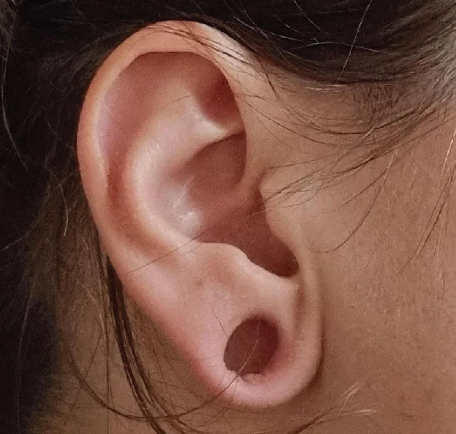 PlugClosureforGaugedEarlobes