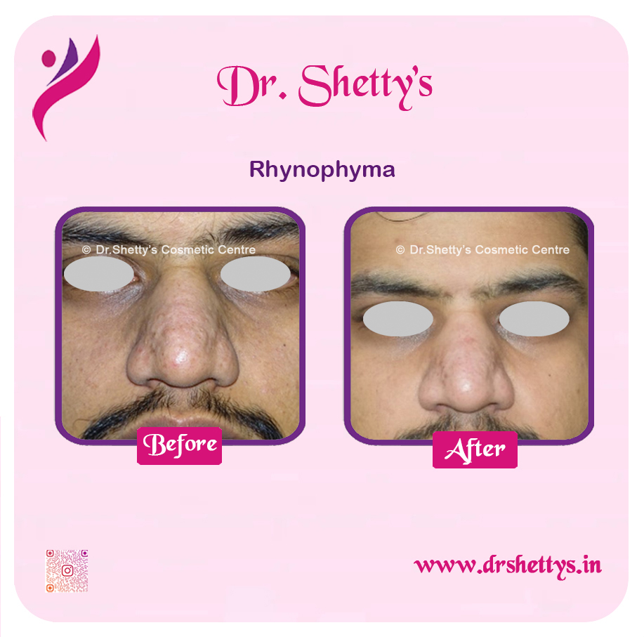 Rhinophyma Treatment 1