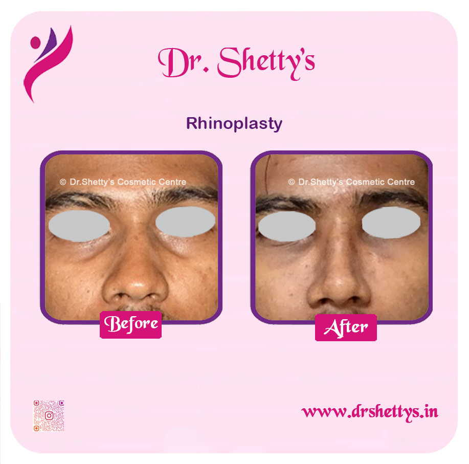 Rhinoplasty Surgery 1