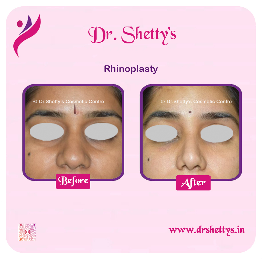 Rhinoplasty Surgery 10