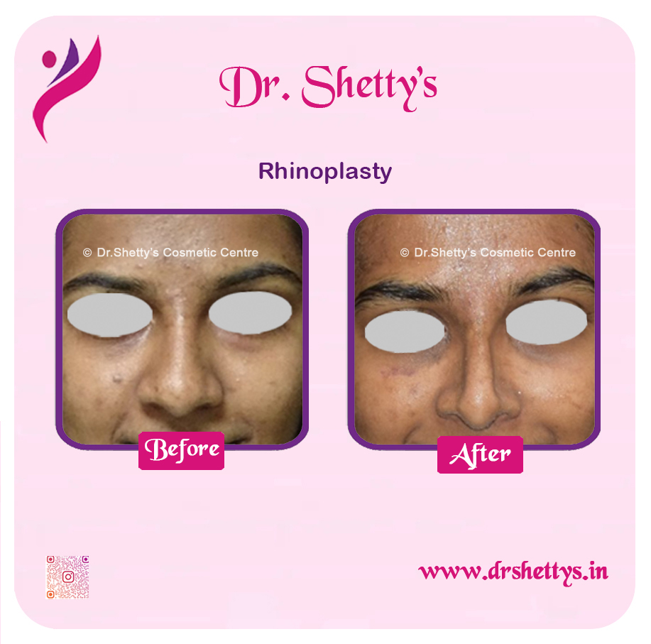 Rhinoplasty Surgery 12