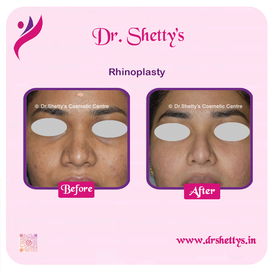 Rhinoplasty Surgery 13
