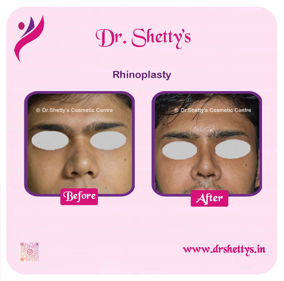 Rhinoplasty Surgery 14