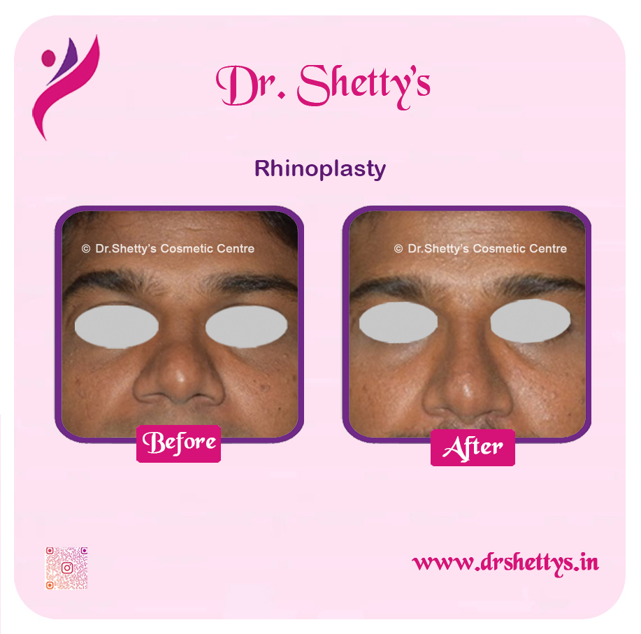 Rhinoplasty Surgery 16