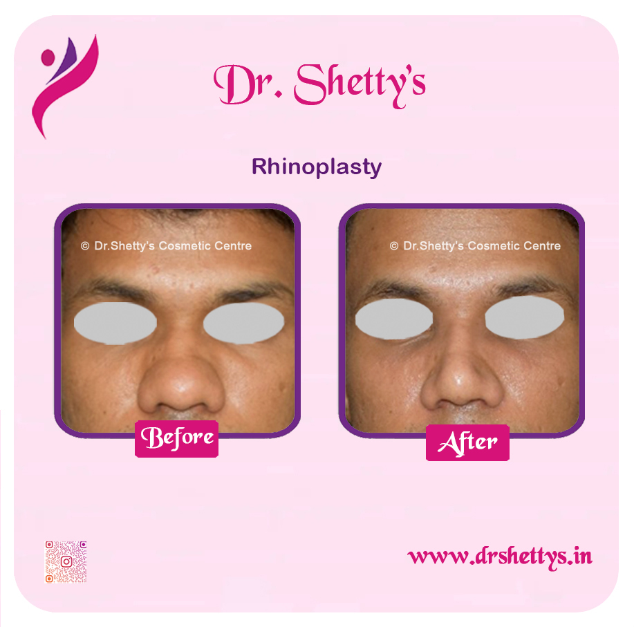 Rhinoplasty Surgery 17