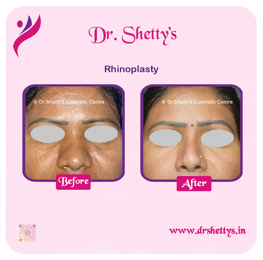 Rhinoplasty Surgery 18