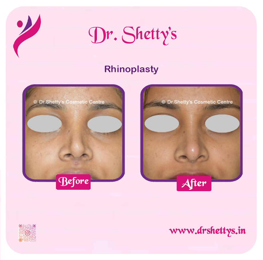 Rhinoplasty Surgery 2