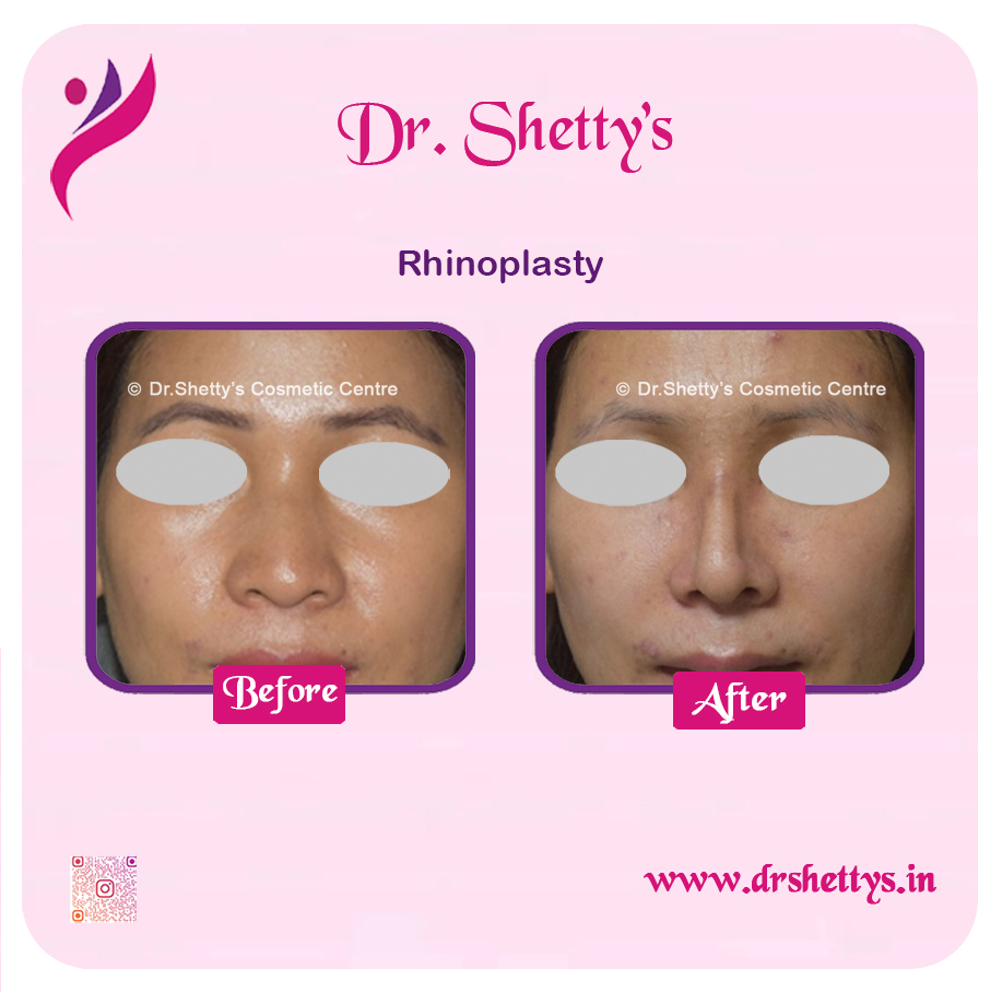 Rhinoplasty Surgery 4
