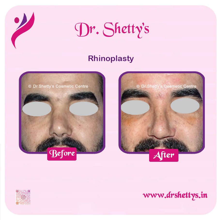 Rhinoplasty Surgery 5