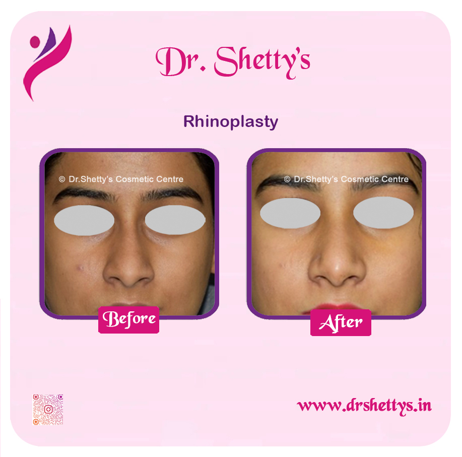 Rhinoplasty Surgery 6