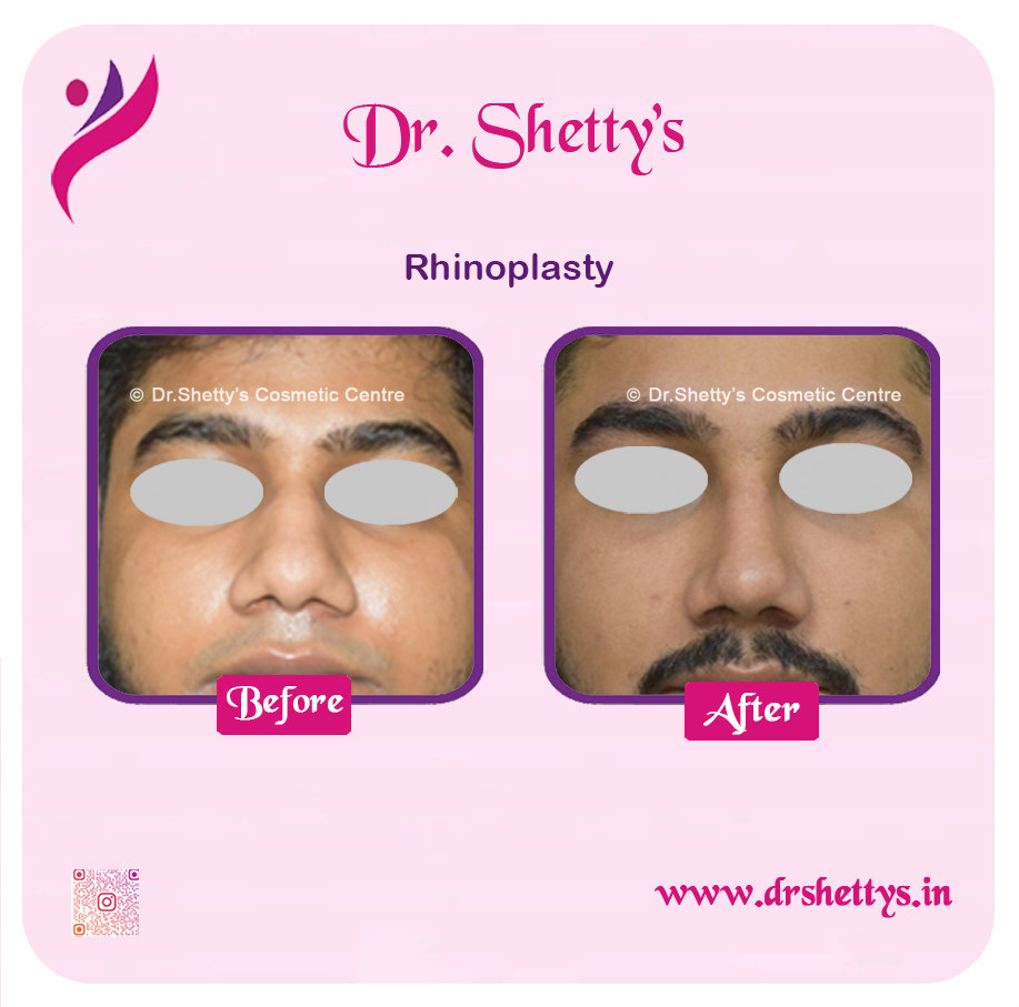 Rhinoplasty Surgery 8