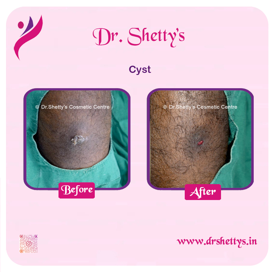 Stitchless Sebaceous Cyst Removal 1