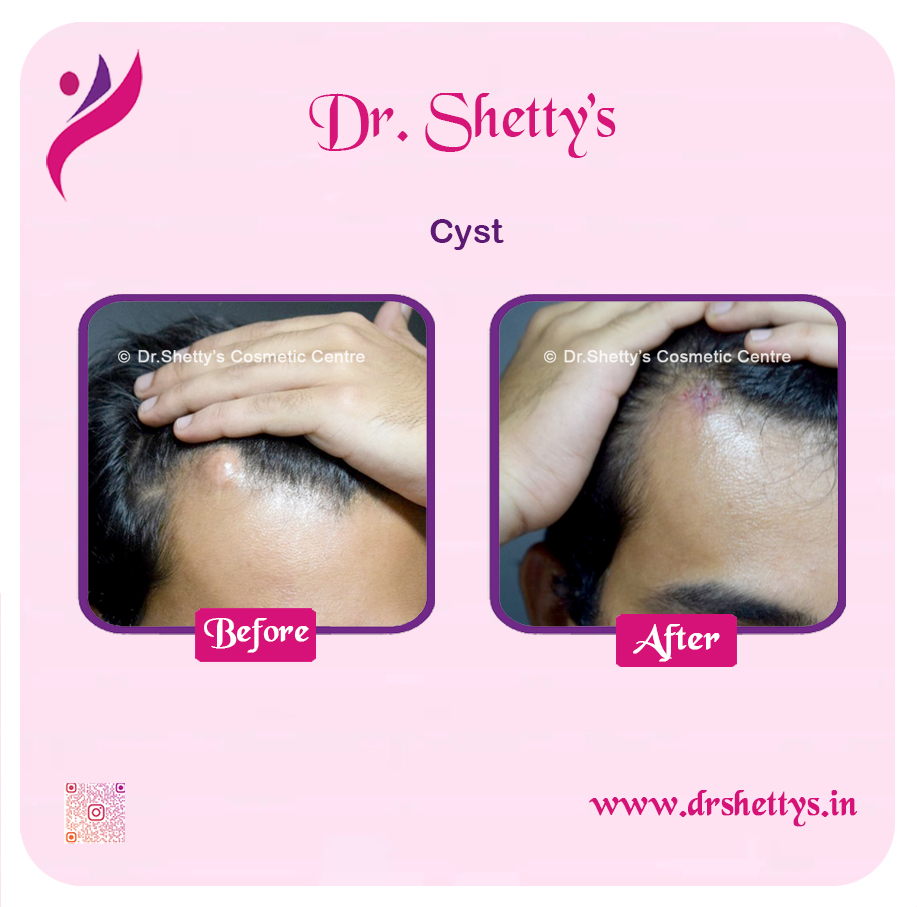 Stitchless Sebaceous Cyst Removal 2