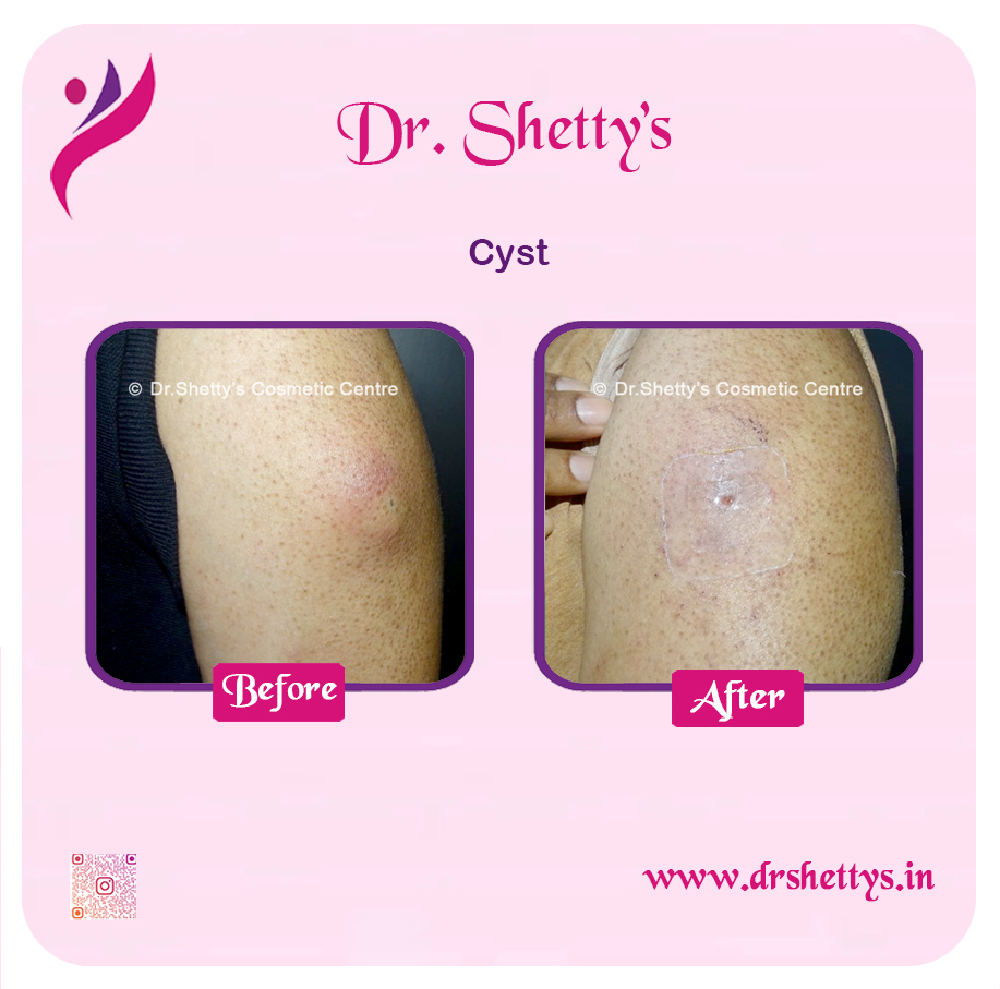Stitchless Sebaceous Cyst Removal 3