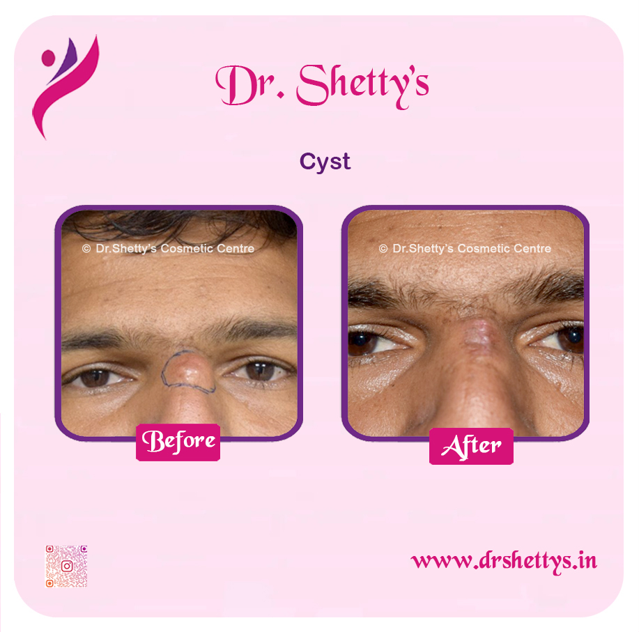 Stitchless Sebaceous Cyst Removal 4