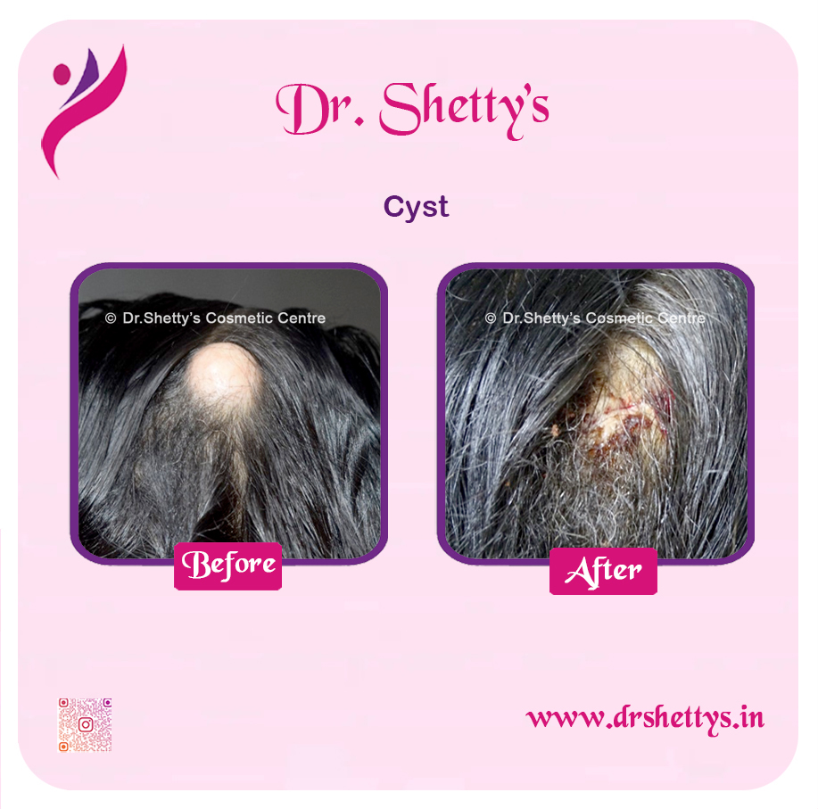 Stitchless Sebaceous Cyst Removal 5