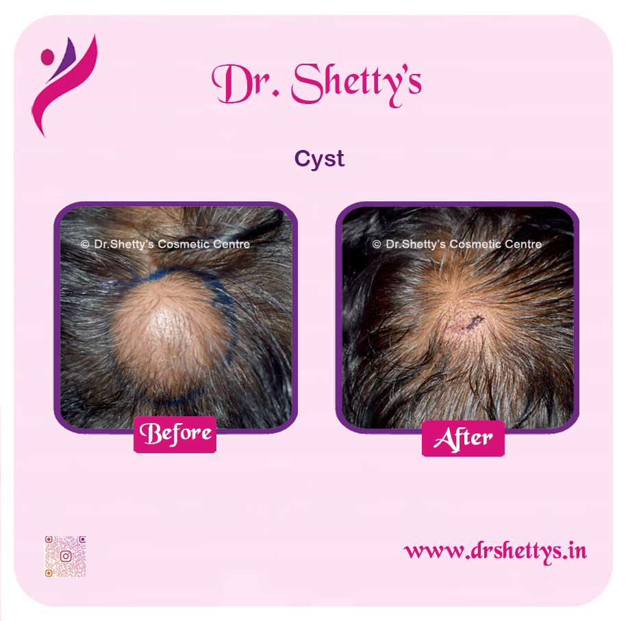 Stitchless Sebaceous Cyst Removal 6