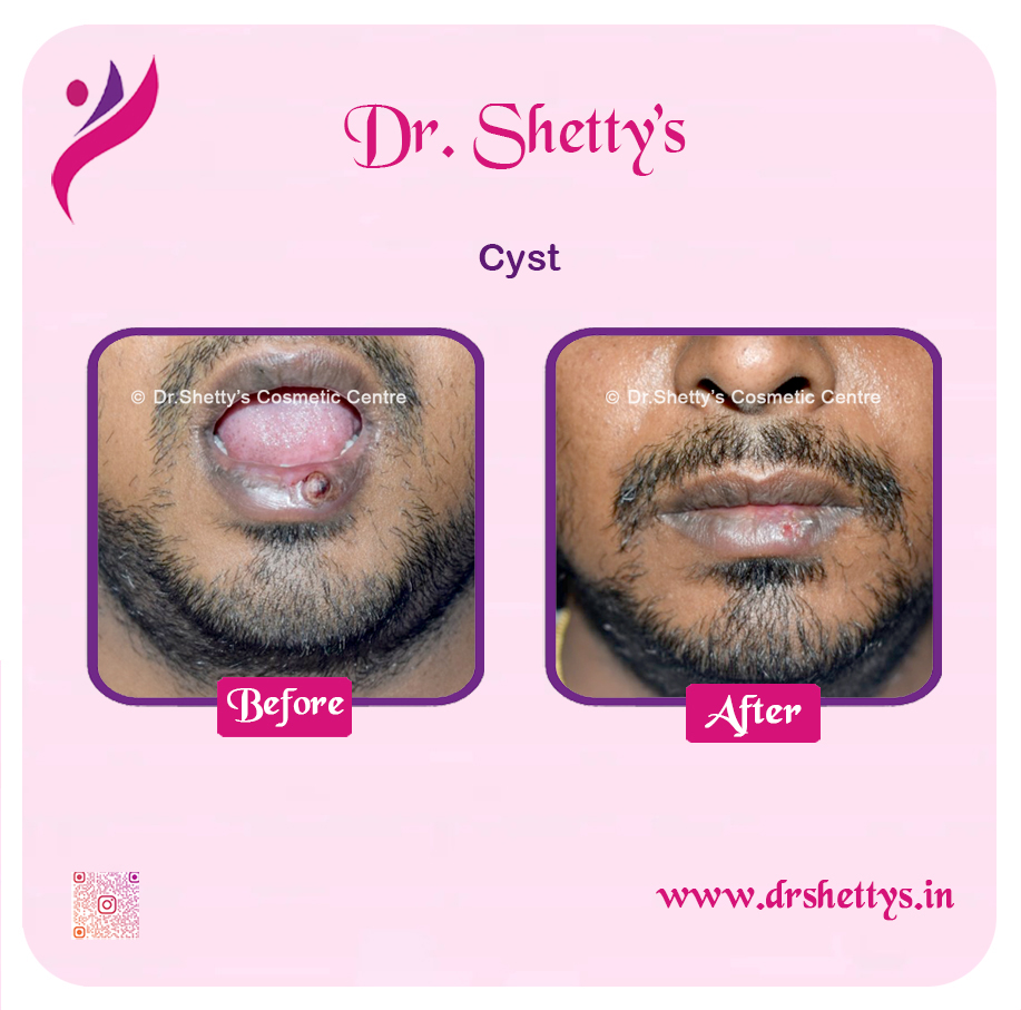 Stitchless Sebaceous Cyst Removal 7