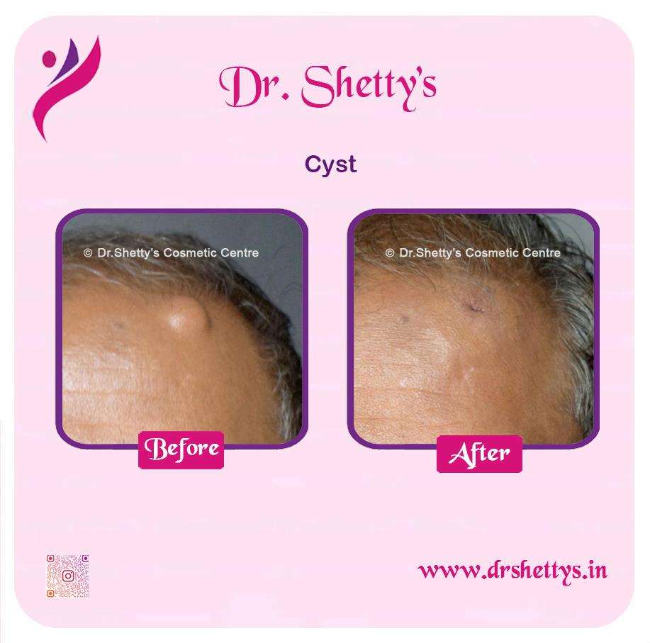 Stitchless Sebaceous Cyst Removal 8