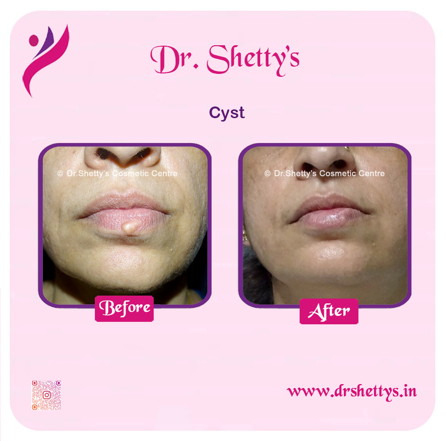Stitchless Sebaceous Cyst Removal 9