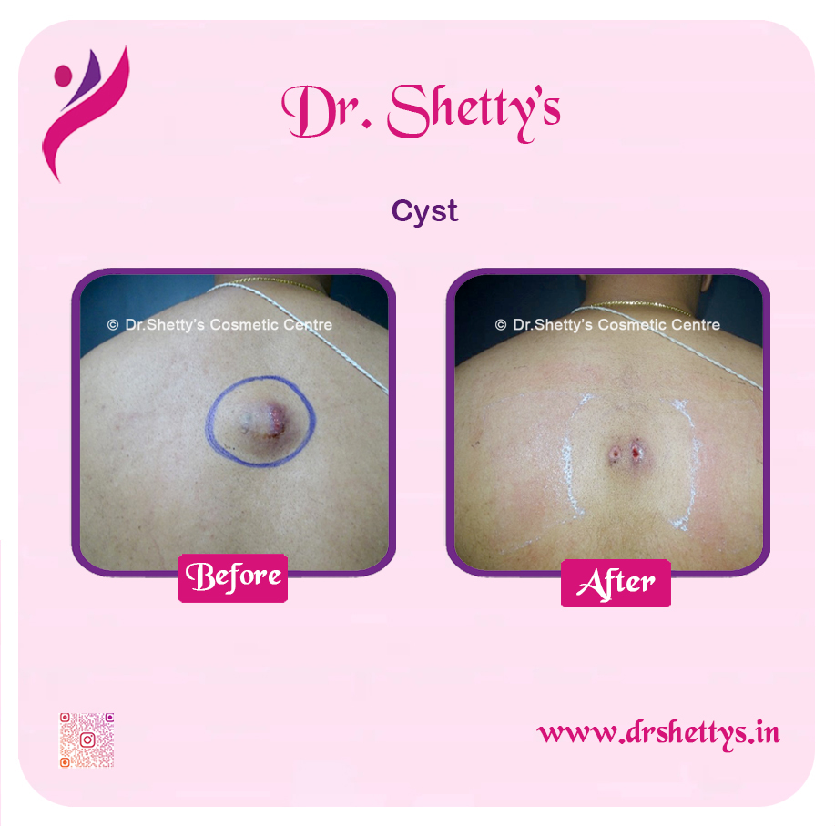Stitchless Sebaceous Cyst Removal