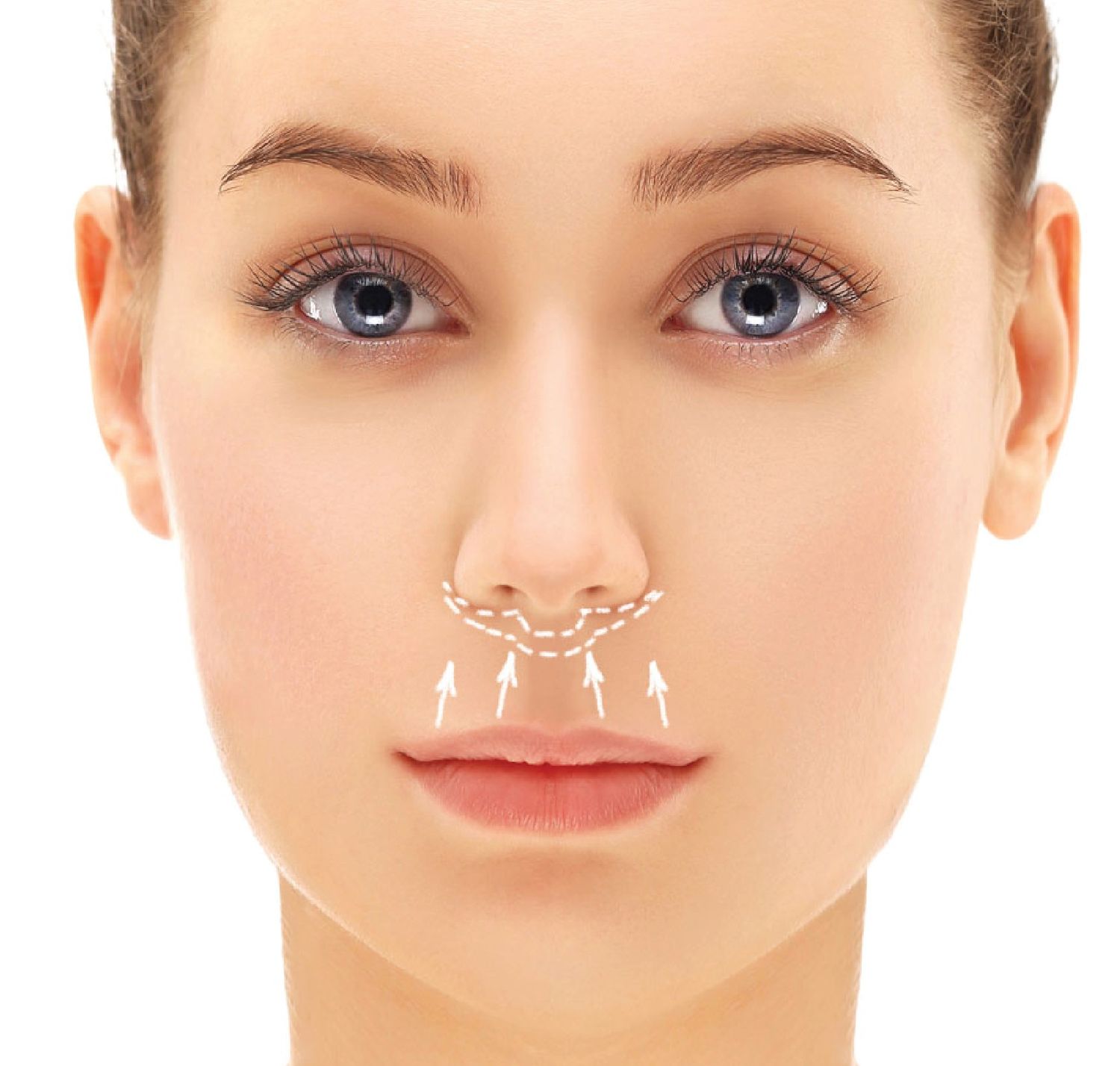 Surgical LipLift