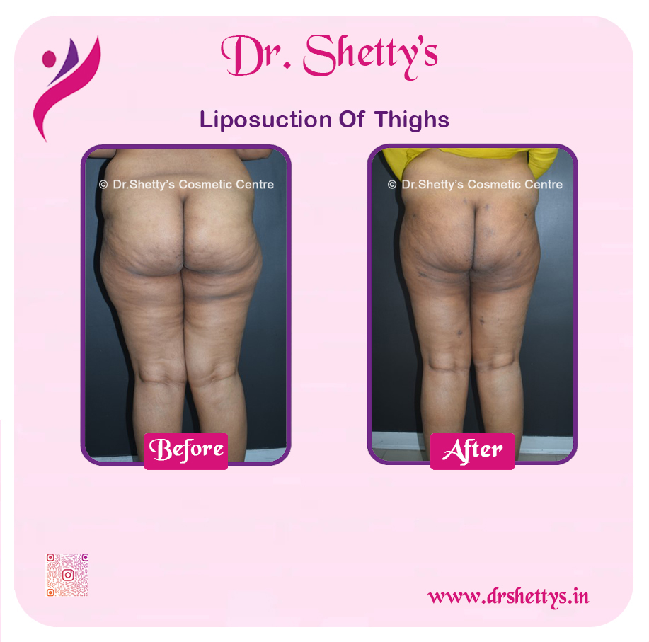 Thigh Lift Surgery 1